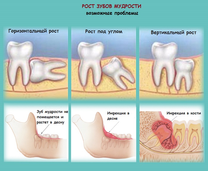 Болит зуб мудрости - стоматология ВитаДент Москва