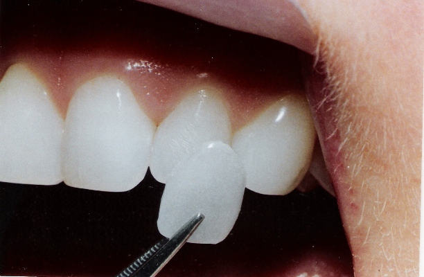 Как лучше вставить зуб: варианты протезирования, преимущества и недостатки