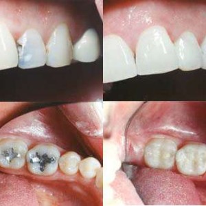 Видео: удаления кариеса зуба