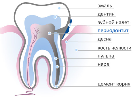 periodontit-lechenie